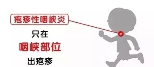 預防皰疹安全知識