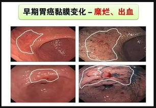 慢性萎縮性胃炎中醫治療方法有哪些
