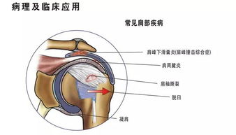 肩周炎的的治療方法有哪些