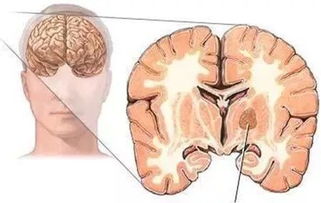 比較小的腫瘤不手術(shù)有哪些方法切除
