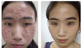 青春痘治療有效方法有哪些