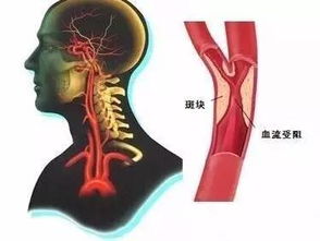 動(dòng)脈硬化的治療方法有哪些動(dòng)脈硬化怎么辦