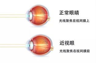 矯正近視的最常用方法有哪些方法
