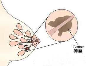 乳腺術(shù)后護理方法有哪些