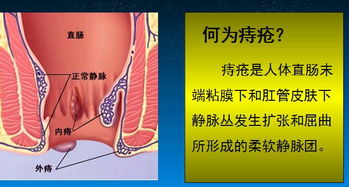 江門(mén)痔瘡治療的方法有哪些