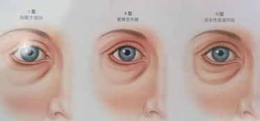 做眼袋注意事項,割眼袋術(shù)后注意事項,割完眼袋注意事項