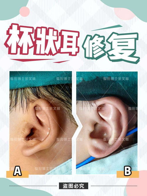 杯狀耳手術的注意事項