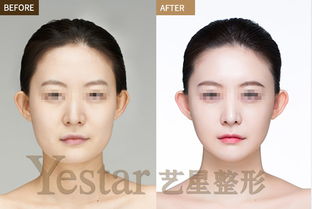 剛打了瘦臉針要注意什么,打瘦臉針后需要注意什么,打完瘦臉針注意事項