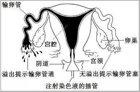 輸卵管造影檢查前注意事項