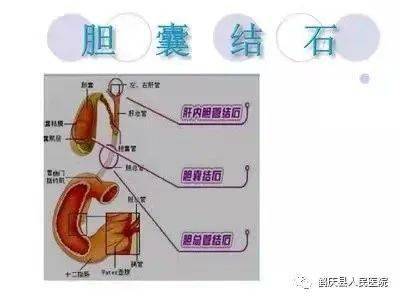 剛做完膽囊切除應注意事項