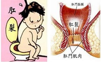 手術后,注意事項,小孩,肛裂