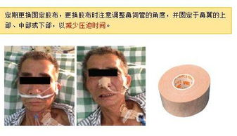 胃管的操作及注意事項,胃管的注意事項和護理,留置胃管的注意事項