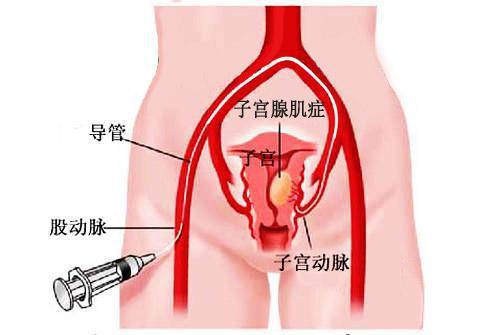 粘膜下子宮肌瘤宮腔鏡手術(shù)后多久可以恢復,粘膜下子宮肌瘤宮腔鏡手術(shù)后十天還有血,粘膜下子宮肌瘤宮腔鏡手術(shù)后多久可以同房