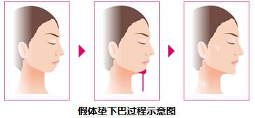 假體下巴做完后的注意事項,假體下巴術后注意事項,假體下巴飲食注意事項