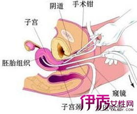 做完宮腔灌注注意事項(xiàng),宮腔灌注注意事項(xiàng),膀胱癌灌注后注意事項(xiàng)