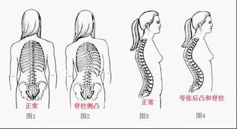 脊柱側彎懷孕注意事項