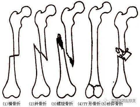 尾骨骨折后注意事項