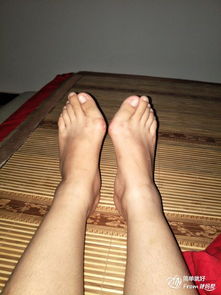 做完拇指外翻手術(shù)后應注意事項