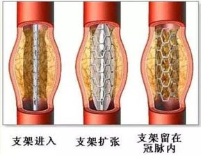 心臟血管狹窄注意事項