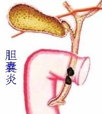 女人膽結石注意事項