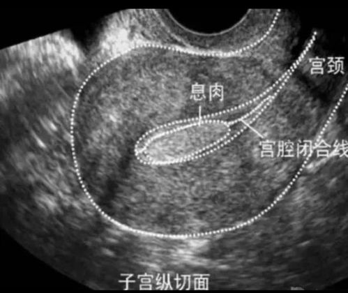 嗓子息肉術(shù)后注意事項