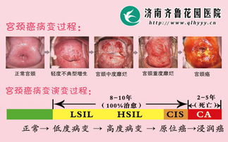 tct和hpv檢查后注意事項,做完tct檢查后注意事項,tct檢查前注意事項