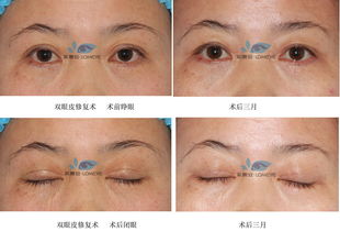 眼睛動(dòng)手術(shù)注意事項