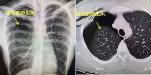 氣胸需要注意事項