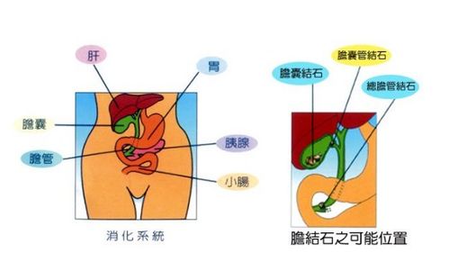 膽結石注意事項及飲食,膽結石患者注意事項,膽結石微創(chuàng  )手術(shù)注意事項