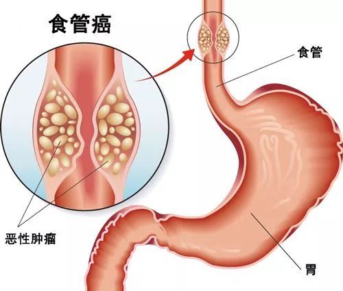 食道癌,注意事項,插管