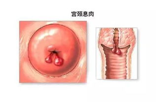孕期宮頸息肉注意事項