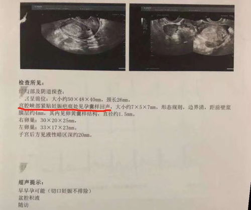 瘢痕子宮引產(chǎn)注意事項