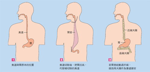 食道癌插管后注意事項