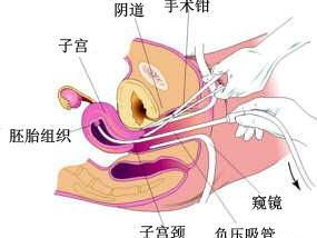 流產(chǎn),注意事項,手術(shù)