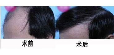 頭發(fā),種植,注意事項