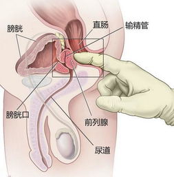 前列腺癌化療注意事項