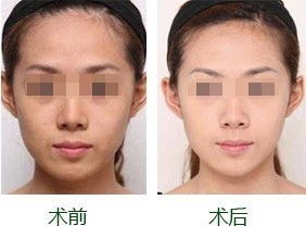 激光點(diǎn)痣注意事項,點(diǎn)陣激光后注意事項,尋常疣激光后注意事項