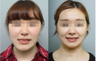 面部不對稱(chēng)整形注意事項