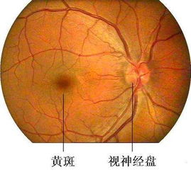 黃斑水腫飲食注意事項,黃斑出血飲食注意事項,眼病白內障術(shù)后飲食有什么注意事項
