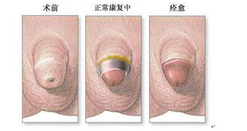 包皮,大連,注意事項,手術(shù)