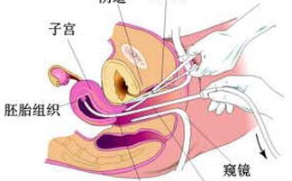 微創(chuàng)人流后注意事項和調(diào)理,無痛人流后注意事項,微創(chuàng)人流手術(shù)后注意事項