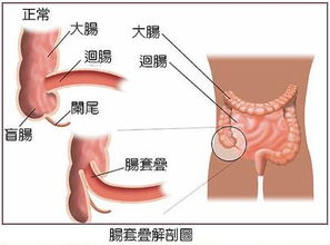 孩子腸套疊后注意事項