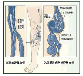 靜脈,闡述,注意事項
