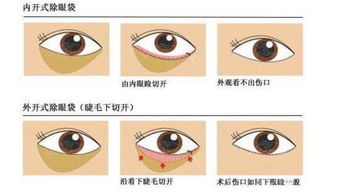 眼袋在家注意事項