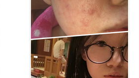臉部過(guò)敏發(fā)注意事項