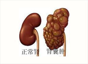 腎上有囊腫注意什么,腎囊腫注意事項(xiàng)及飲食,腎囊腫術(shù)后注意事項(xiàng)