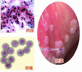尖銳濕疣冷凍后注意事項