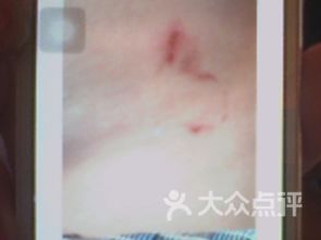 注意事項,減肥,拔罐