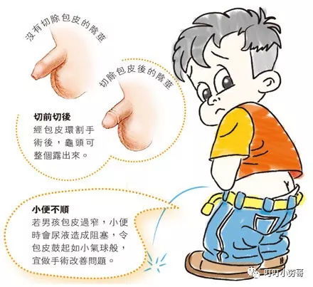 割包皮兒童注意事項
