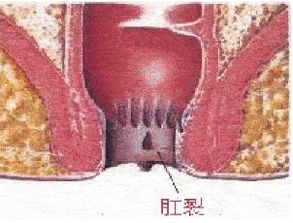 肛裂流血注意事項